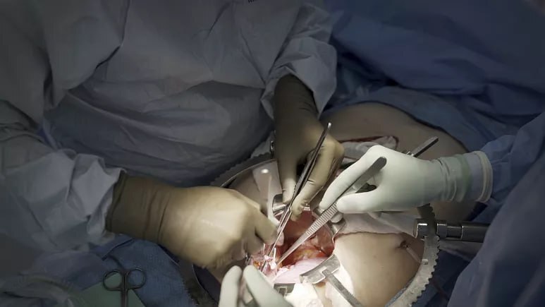 پیوند اندام حیوانات به انسان؛ کلیه خوک پیوندی پس از یک ماه هنوز به صورت نرمال کار می‌کند