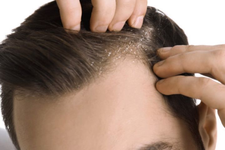 چرا سرم شوره می‌زند؟