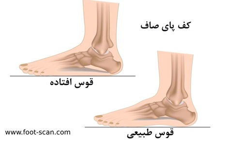 ناهنجاری کف پای صاف