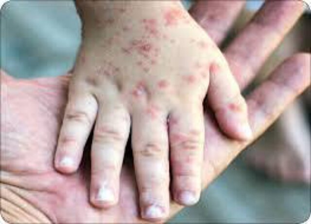 شیوع فصلی آبله‌مرغان؛ شروع از زمستان تا اوج در بهار